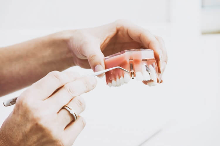 ¿Es doloroso un implante dental?