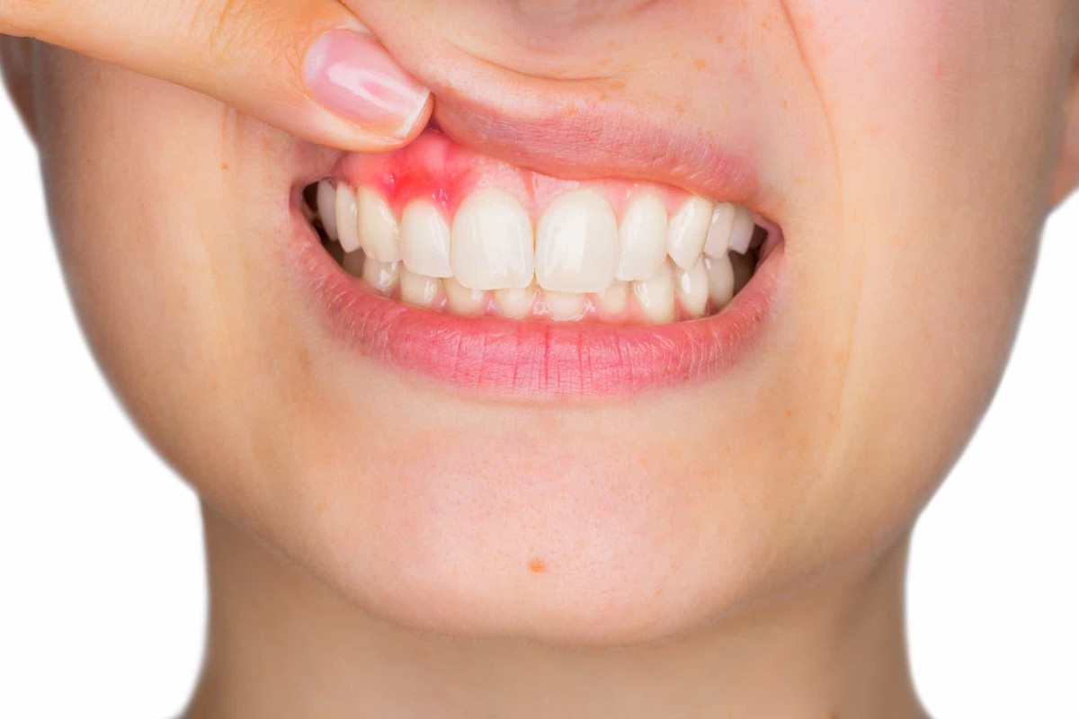 teléfono pompa Exclusión Cómo bajar la inflamación de las encías | Almara Dental