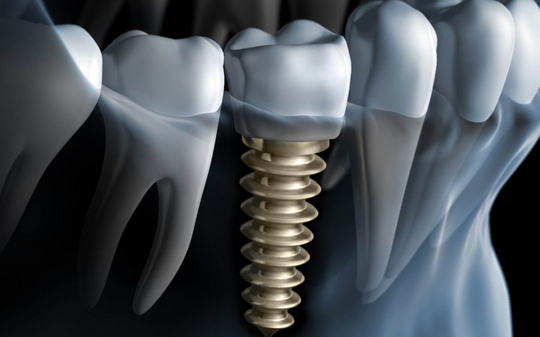 Proceso de colocación de un implante dental