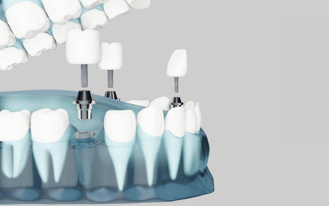 Cuidados que requiere un implante dental tras su colocación