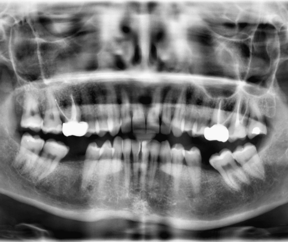 Radiografía Movimiento de los dientes vecinos
