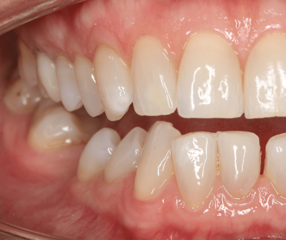 Foto Movimiento de los dientes vecinos