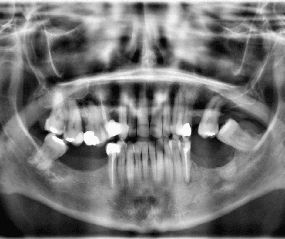 Radiografía Pérdida de hueso