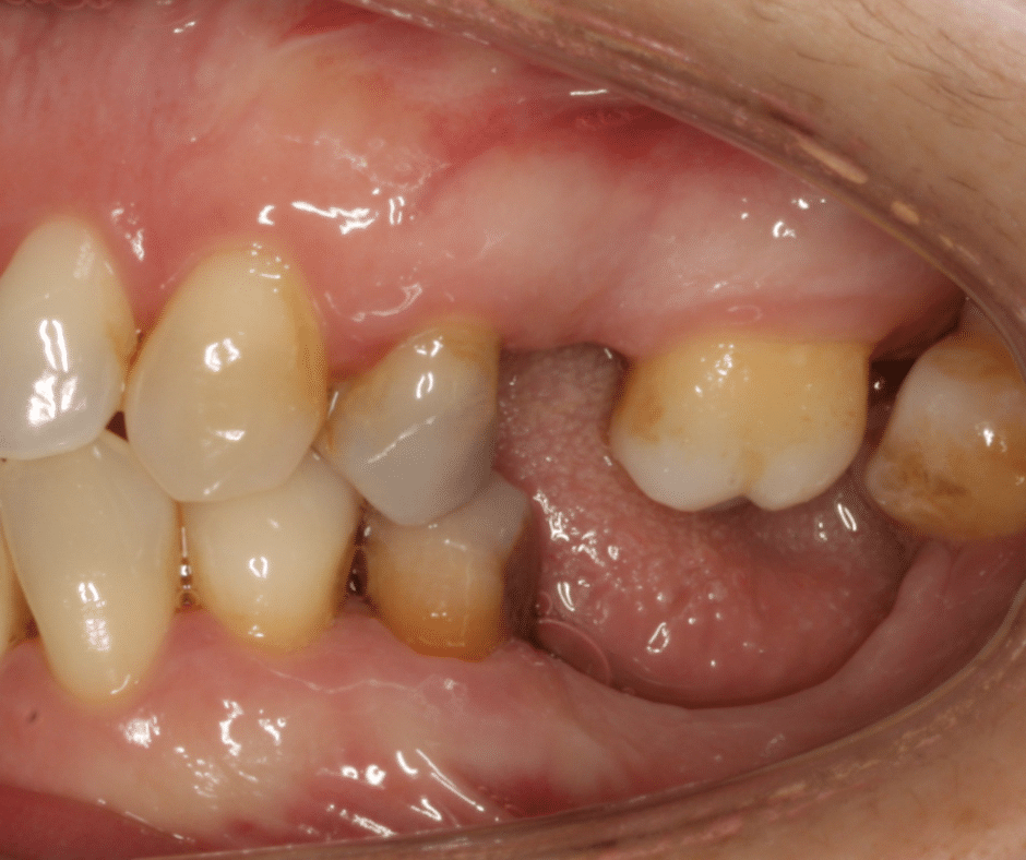 Foto Pérdida de hueso