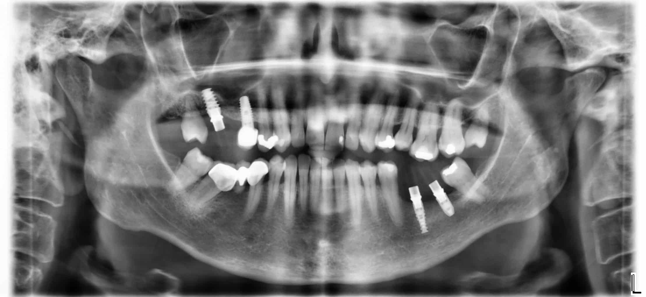 Radiografía Extrusión del diente opuesto