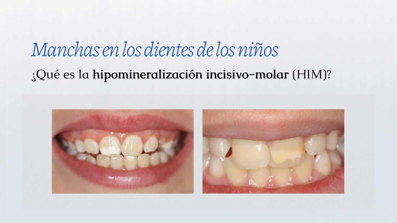 Manchas en los dientes de los niños: ¿qué es la hipomineralización incisivo-molar (HIM)?